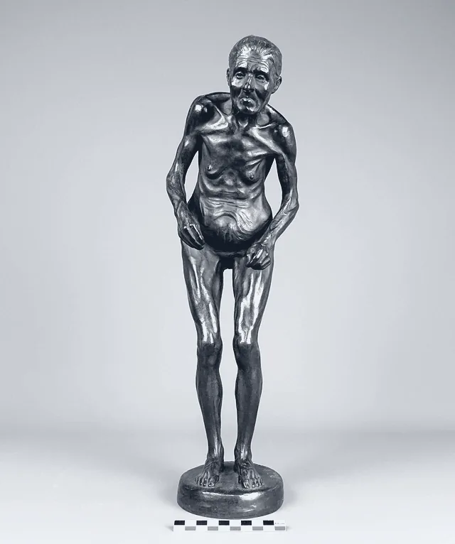 Bronze statuette of a woman with Parkinson's disease, stooped, by Paul Richer, 1895